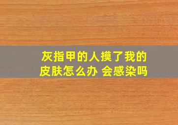 灰指甲的人摸了我的皮肤怎么办 会感染吗